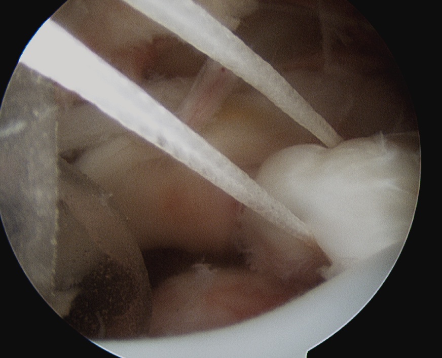 SSC Tagging Suture Subacromial Space